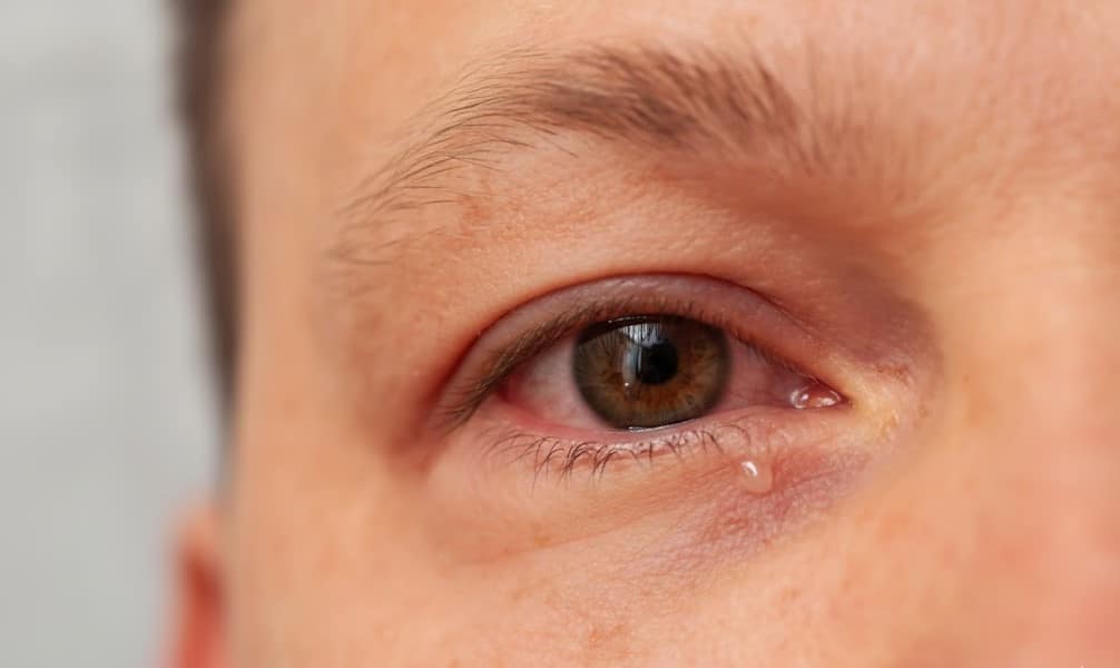 Close-up of eye redness and inflammation caused by Anterior Uveitis.