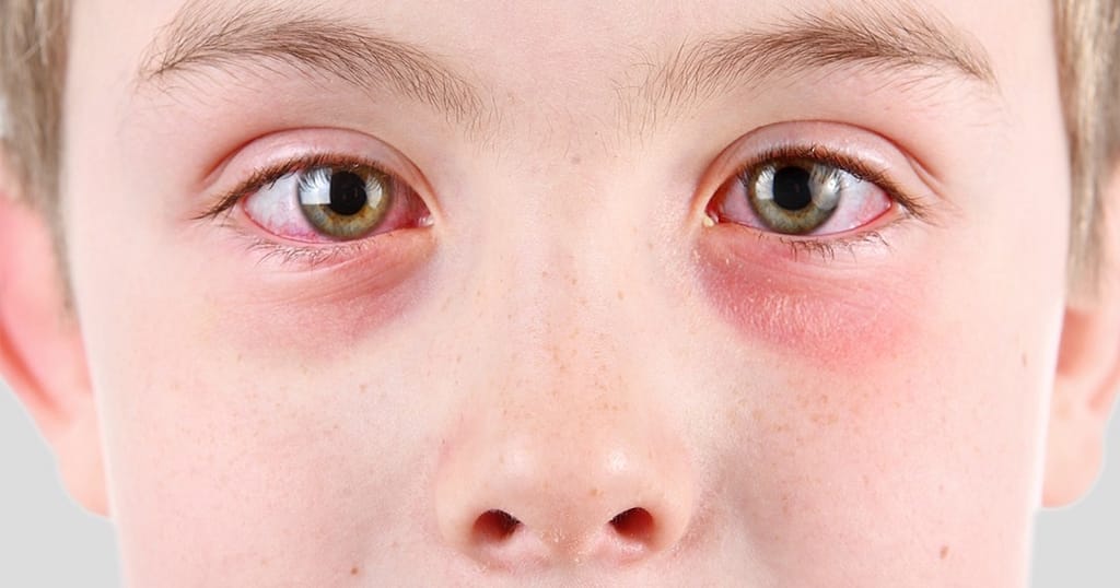 Conjunctivitis (Pink Eye) symptoms and treatments