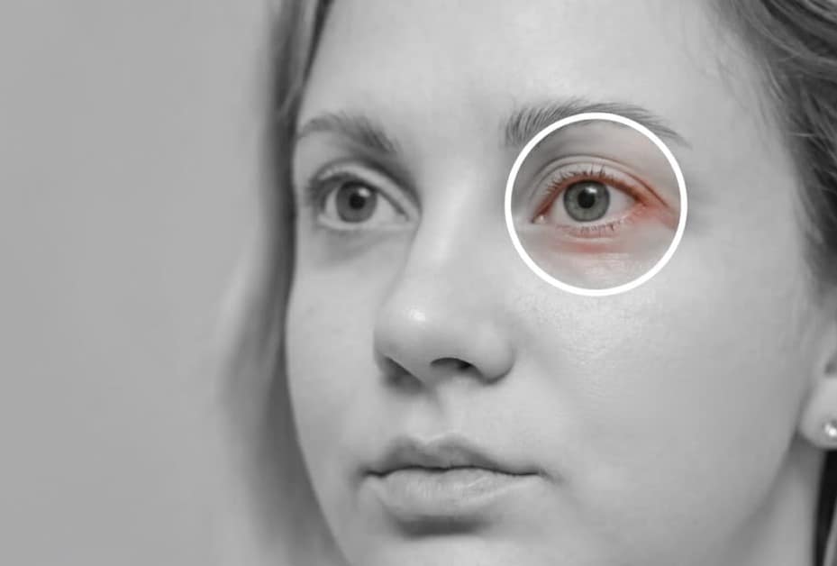 Dry eyes caused by hormonal imbalance affecting eye health